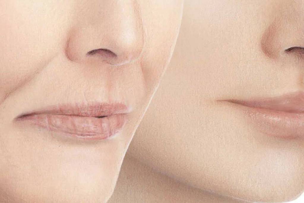 Redefine Ageless Elegance with Wrinkle Fillers in Merseyside