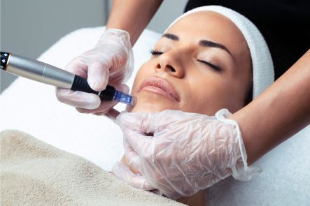 What is Microneedling Merseyside?